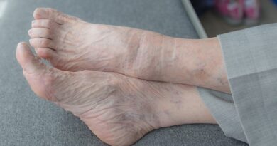静脈の静脈炎や炎症に取り組むために家庭の治療法