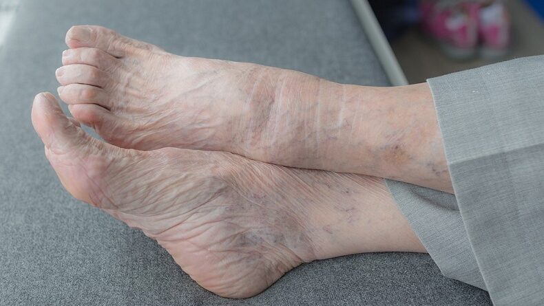静脈の静脈炎や炎症に取り組むために家庭の治療法