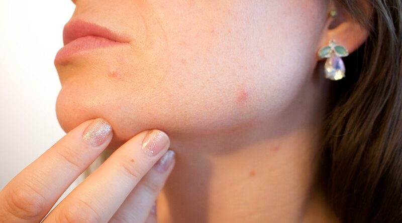 Veroorzaakt gekruid eten acne?