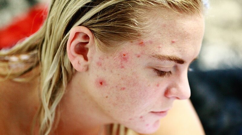 O que indica a acne nestas 5 partes do seu rosto